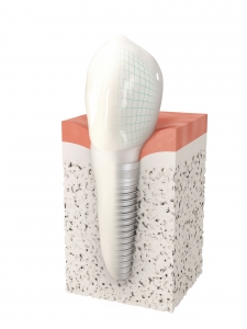 Implant-Dentaire